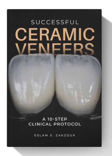 Successful Ceramic Veneers: 10 Steps Clinical Protocol